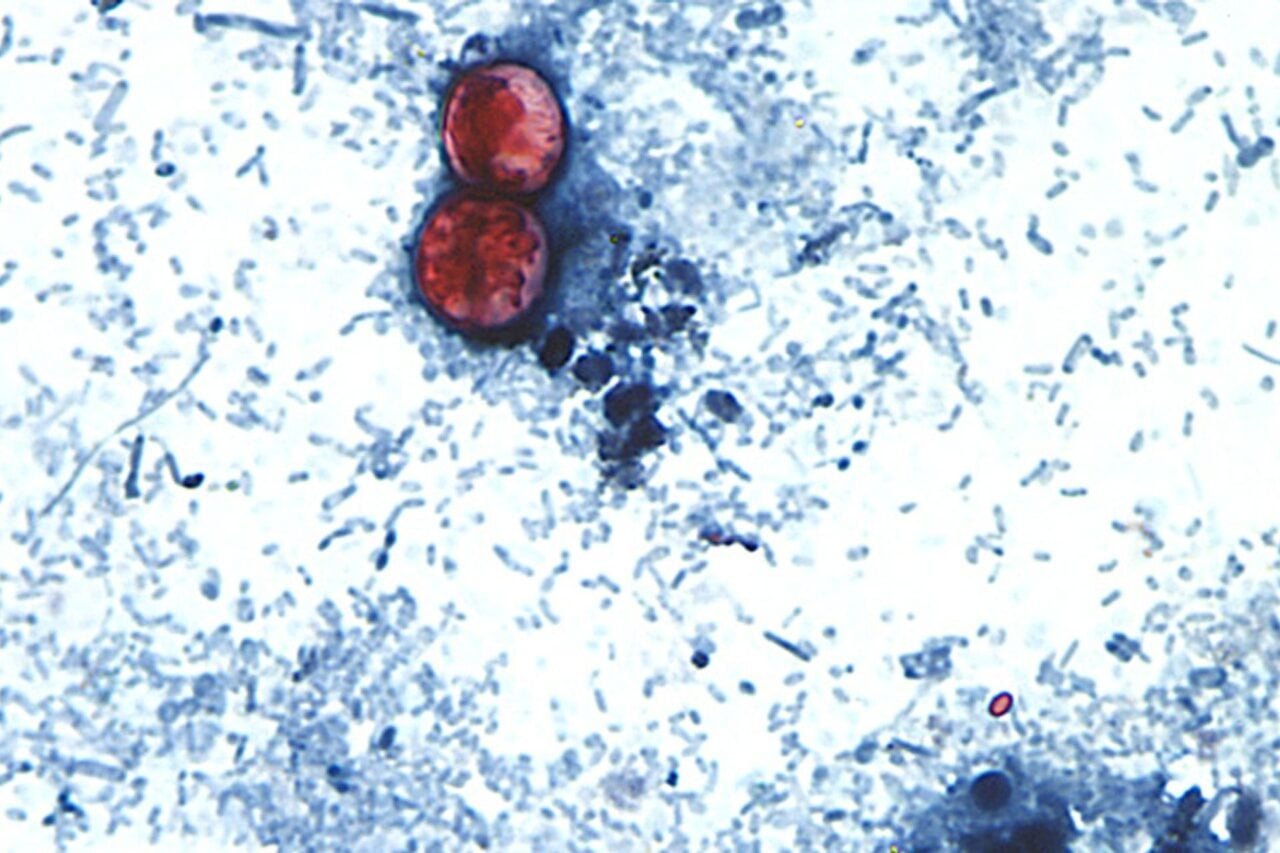 Explosive Diarrhea Outbreak Hits Grim New Milestone as Cases Top 1,000